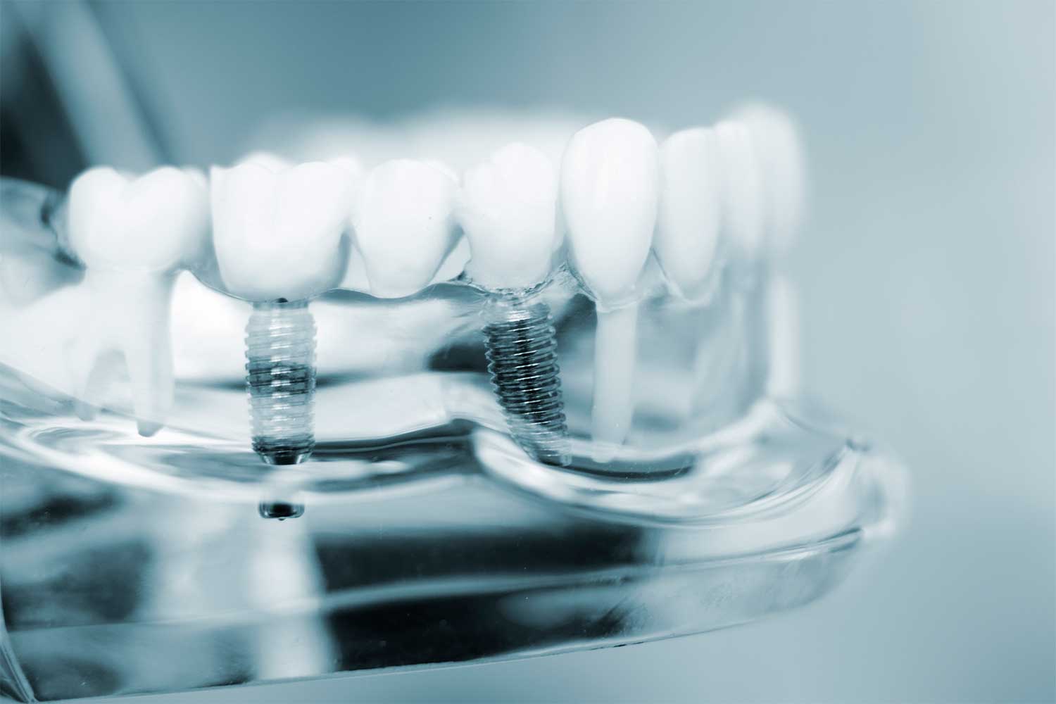 Are Dental Implants Worth It Chattanooga TN